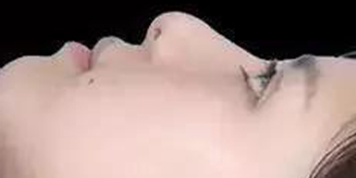 自體軟骨墊鼻尖術(shù)前