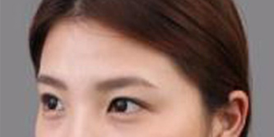 玻尿酸豐額頭術前