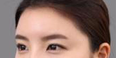 玻尿酸豐額頭術后