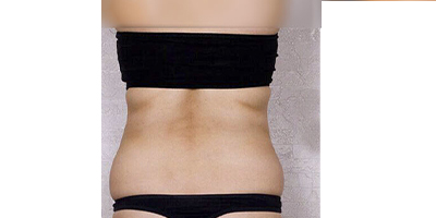 超聲溶脂瘦背部術(shù)前