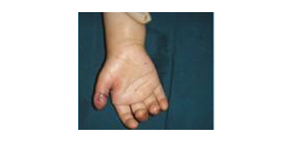 多指矯正術(shù)后