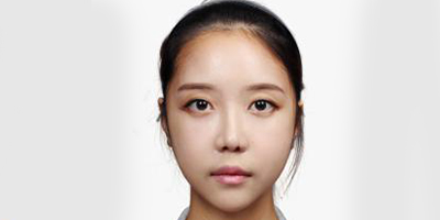 手術(shù)縮鼻翼術(shù)后