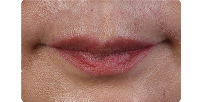 麗芙莎EPT自體抗衰術(shù)前