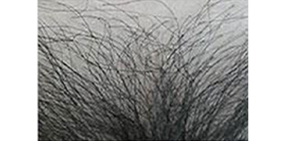 種植私密毛發(fā)術(shù)后