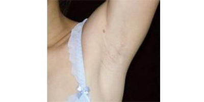 脫腋毛術(shù)后