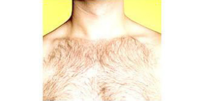 種植胸毛術(shù)后