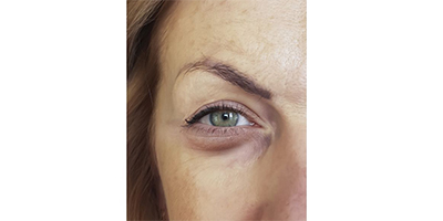 玻尿酸豐眼窩術(shù)前