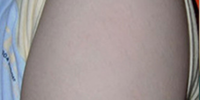 擴(kuò)張器祛疤術(shù)后