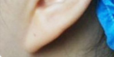 自體脂肪豐耳垂術(shù)前