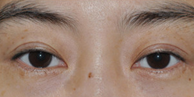 眼部修復(fù)術(shù)前
