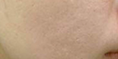 微針美塑術(shù)后