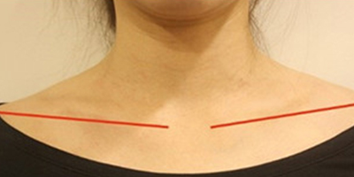 注射瘦肩肌術(shù)后