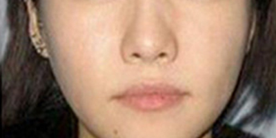 自體脂肪全臉填充術(shù)后