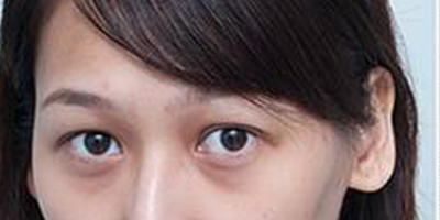 自體脂肪豐淚溝術(shù)前