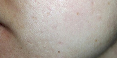 化學(xué)換膚術(shù)后