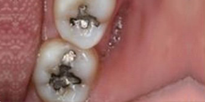 根管治療術(shù)前