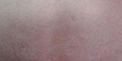 注射祛疤術(shù)后