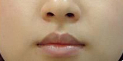 水氧活膚術(shù)后