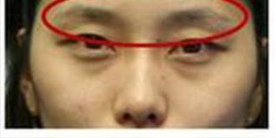 自體脂肪豐眉弓術前