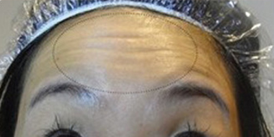 注射去動(dòng)態(tài)紋術(shù)前