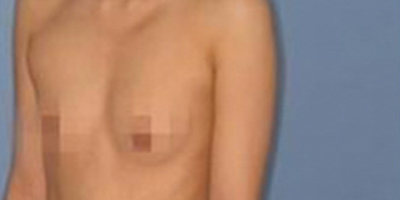 自體脂肪隆胸術前