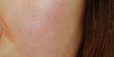 激光祛紅血絲術(shù)前