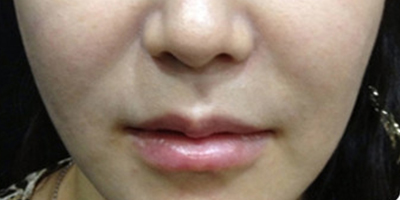 黑臉娃娃術(shù)后