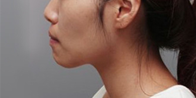 頜面正畸術(shù)前