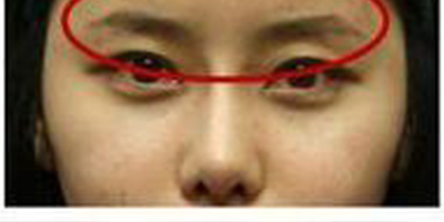 自體脂肪豐眉弓術后