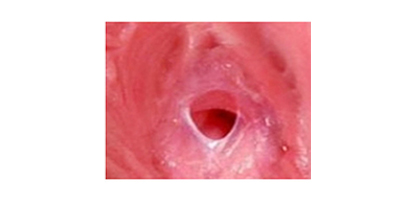 處女膜修復(fù)術(shù)后