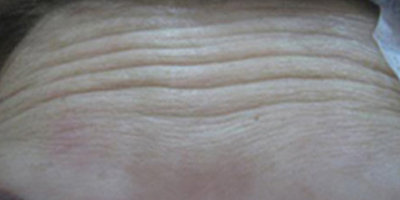 注射去抬頭紋術(shù)前