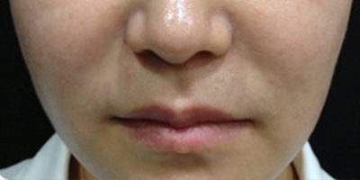 黑臉娃娃術(shù)前