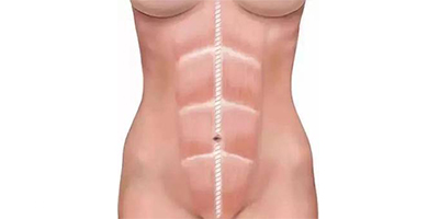 產(chǎn)后塑形術(shù)后