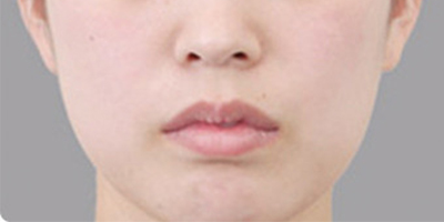 脂肪填充失敗修復術前