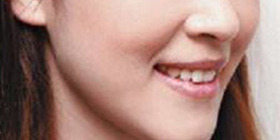 自體脂肪豐蘋果肌術(shù)后