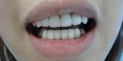 牙齒綜合術(shù)后