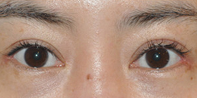 眼部修復(fù)術(shù)后