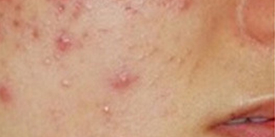 清痘針術(shù)前