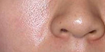 射頻微針術(shù)后