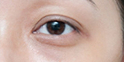 自體脂肪豐眼窩術前