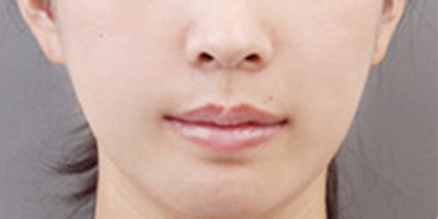 脂肪填充失敗修復術后