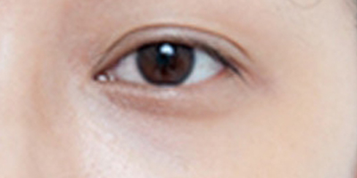 自體脂肪豐眼窩術后