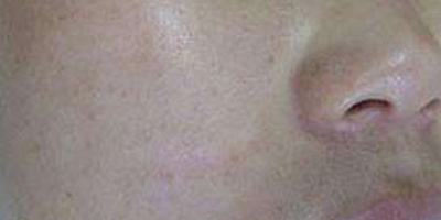 手術(shù)祛疤術(shù)后