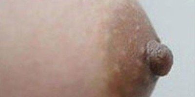 乳頭縮小術后