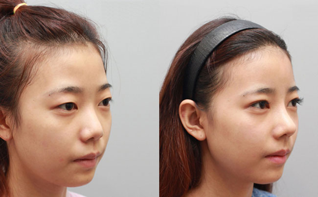 耳軟骨隆鼻的優(yōu)缺點是什么？肋軟骨隆鼻和耳軟骨隆鼻有什么區(qū)別？