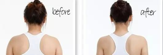 后背抽脂那些人可以做？吸脂瘦肩膀多少錢(qián)？