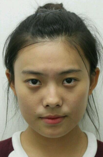 上海新健威醫(yī)療美容門診部張威雙眼皮案例效果分享