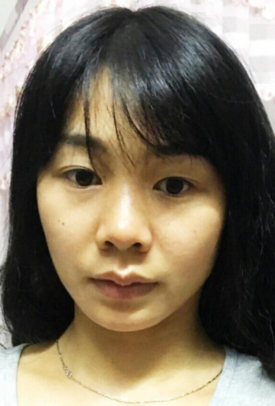  廈門華美名媛整形美容醫(yī)院俞積貴雙眼皮案例效果分享