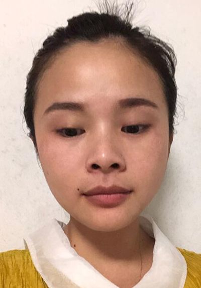 長春中妍醫(yī)療美容醫(yī)院趙勝友雙眼皮案例效果分享