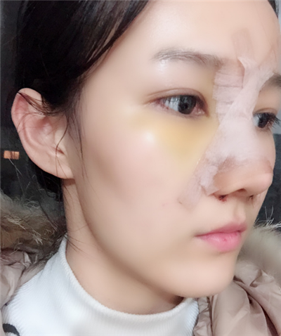 長(zhǎng)春中妍醫(yī)療美容醫(yī)院王軍隆鼻案例效果分享